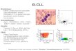 B-CLL Morphologie: Kleine Lymphozyten mit schmalem Zyto-plasmasaum; dichtes Chromatin, z.T. zu groben Klumpen kondensiert, keine Nukleoli; Kernschatten