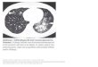 Wielpütz, Mark O.; Heußel, Claus P.; Herth, Felix J. F.; Kauczor, Hans-Ulrich Radiologische Diagnostik von Lungenerkrankungen: Beachtung der Therapieoptionen