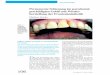 Permanente Schienung im parodontal geschädigten Gebiß … · 106 Dent Implantol 10, 2, 106 - 111 (2006) Permanente Schienung im parodontal geschädigten Gebiß mit Wieder-herstellung