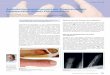 Amputationsverletzungen am Fingerendglied ... - safw.ch · CURRICULUM Schweiz Med Forum 2014;14(18):356–360 357 Wann soll mit der Folienbehandlung begonnen werden? Die erste Reinigung