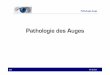 Pathologie des Auges - …sdeceaed5a9bf4e47.jimcontent.com/download/version/1389351087/... · Hordeolum = ….eine eitrige, schmerzhafte, bakterielle Entzündung der Drüsen (Zeiss