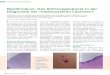 Rezidivnävus: Das Schreckgespenst in der Diagnostik der ... · 40| |ärztliches journal onkologie 5 2017 sion benigner melanozytärer Läsionen jeglichen Dysplasiegrades abgesehen