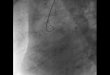 Akute Notfälle der thorakalen Aorta - leipzig-kardiologie.de · • Ruptur oder drohende Ruptur ... Rupturiertes Aneurysma . Rupturiertes Aneurysma Female patient, 75 years, ruptured