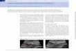 Duplexsonografie der tiefen Beinvenenthrombose · Pitfall | Kompression mit dem Schallkopf auf den Knochen bringt die daneben liegende Venen nicht zum Kollabieren ( Abb. 7). Häufige