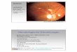 Vorlesung Auge und Allgemeinerkrankungen 10.7.04 · 2 Polycyt-hämie Dilatierte, gewundene Arterien und Venen Papillenödem multiple intraretinale Blutungen. Auge und Allgemeinleiden