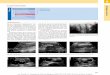 Thieme: Sonografische Differenzialdiagnose · Nierengefäßmissbildungen Hierunter fallen intra- oder extrarenaleAneu-rysmata, arteriovenöse Fisteln undextrarenale atypische Gefäßverläufe