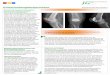 Patienteninfo Kniescheib proth orange - eduardus.de · Die minimal-invasive Kniescheiben-prothese bei Gelenkverschleiß des Kniescheibengelenkes Schmerzen im Bereich der Kniescheibe