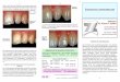 I - 5 - - 6 · Beschleifen und Überkronen der Zähne behoben wurden, ist es heute mit den schon vorher beschriebenen Kompositen möglich, die Zähne sehr viel schonender zu korrigieren
