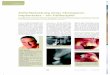 Sofortbelastung eines Champions- Implantates – ein ... · Ubistesin 1/200 000:Lokalanästhesie (Infiltrations- und Leitungsanästhesie) für Routineeingriffe in der Zahnheilkunde