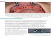 Schablonengeführte Sofortimplantation und Sofortversorgung · 2020-01-15 · OsseoSpeed Profile EV-Implantate (Ø 4,2 mm, Länge von 13,0 mm) nach distal geneigt eingesetzt, um das