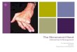 The Rheumatoid Hand - siddharthatrust.com€¦ · Hand Deformities " Ulnar drift of fingers & Radial deviation of wrist " Swan neck deformity " Boutonniere deformity " Mallet finger